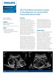 V9-2 PureWave transducer assists in the diagnosis of a severe fetal intracranial abnormality