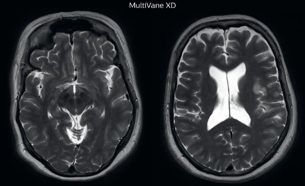 UVM case 2 motion artifact MultivaneXD 