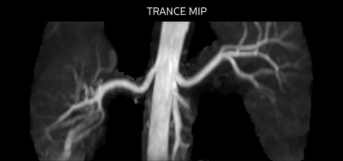 TRANCE MIP