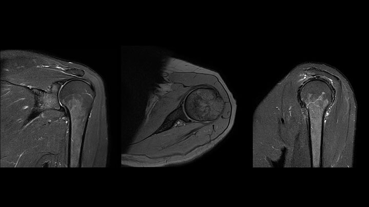 Shoulder MRI