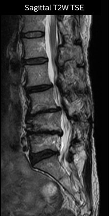 sagittal t2w tse