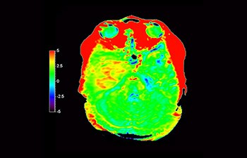 Astrocytoma