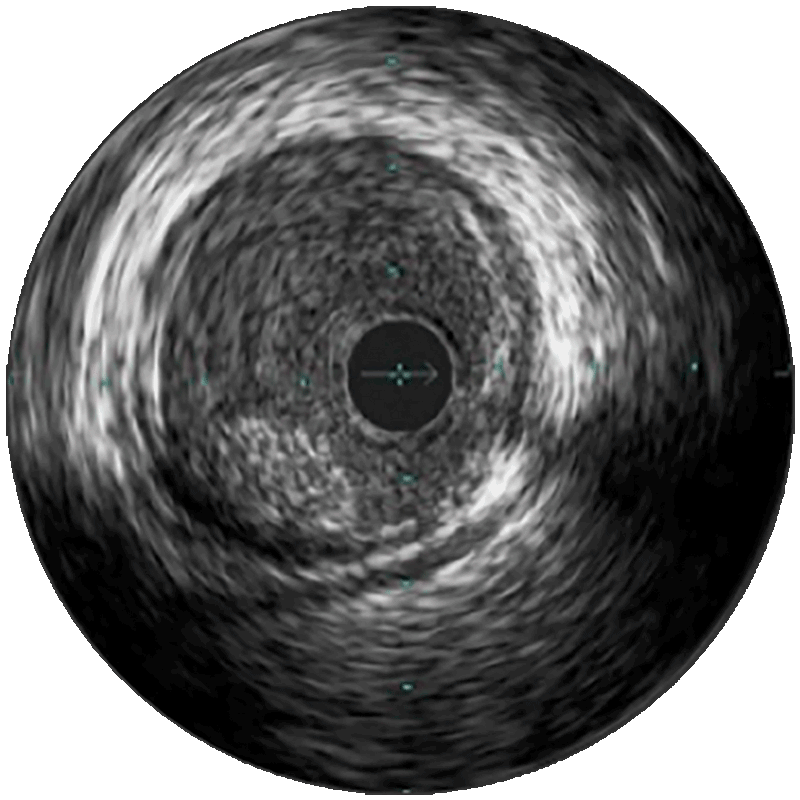 Grayscale plaque visualization reversed