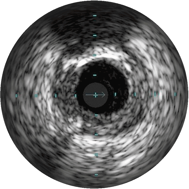 Grayscale plaque visualization