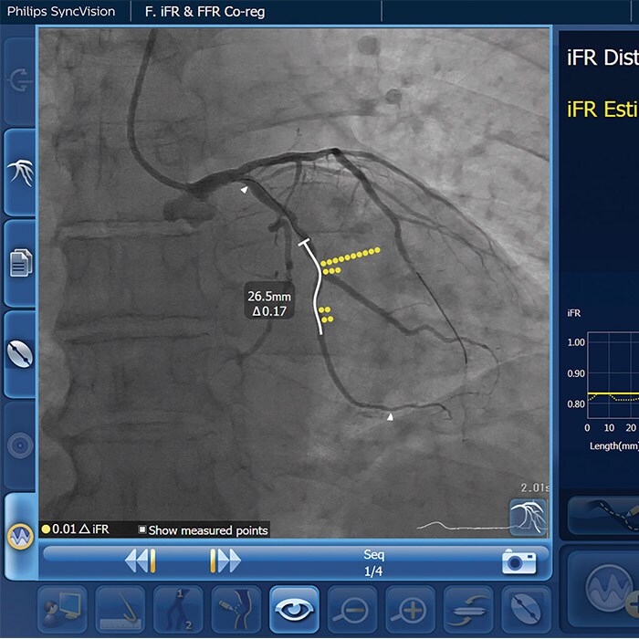 IntraSight iFR Coreg visual