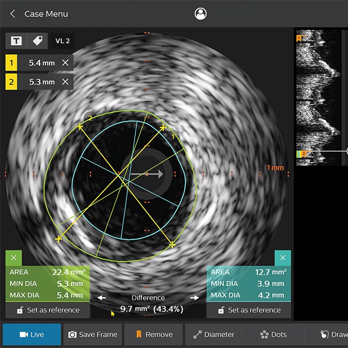 IVUS monitor image
