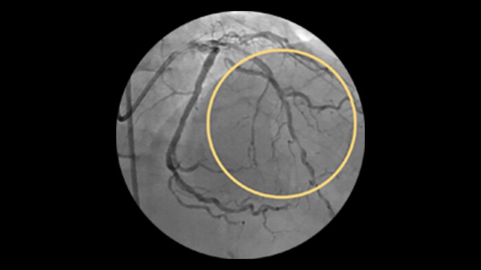 Diffuse Disease