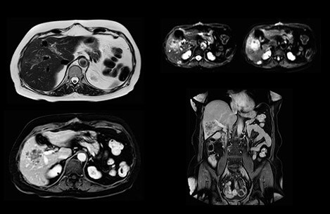 liver mri rectum cancer image 1